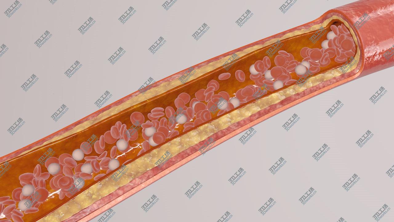 images/goods_img/2021040232/blocked blood vessel animation 3D model/4.jpg